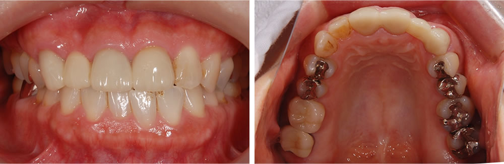 前歯の審美修復症例 | 世田谷区千歳烏山の歯医者