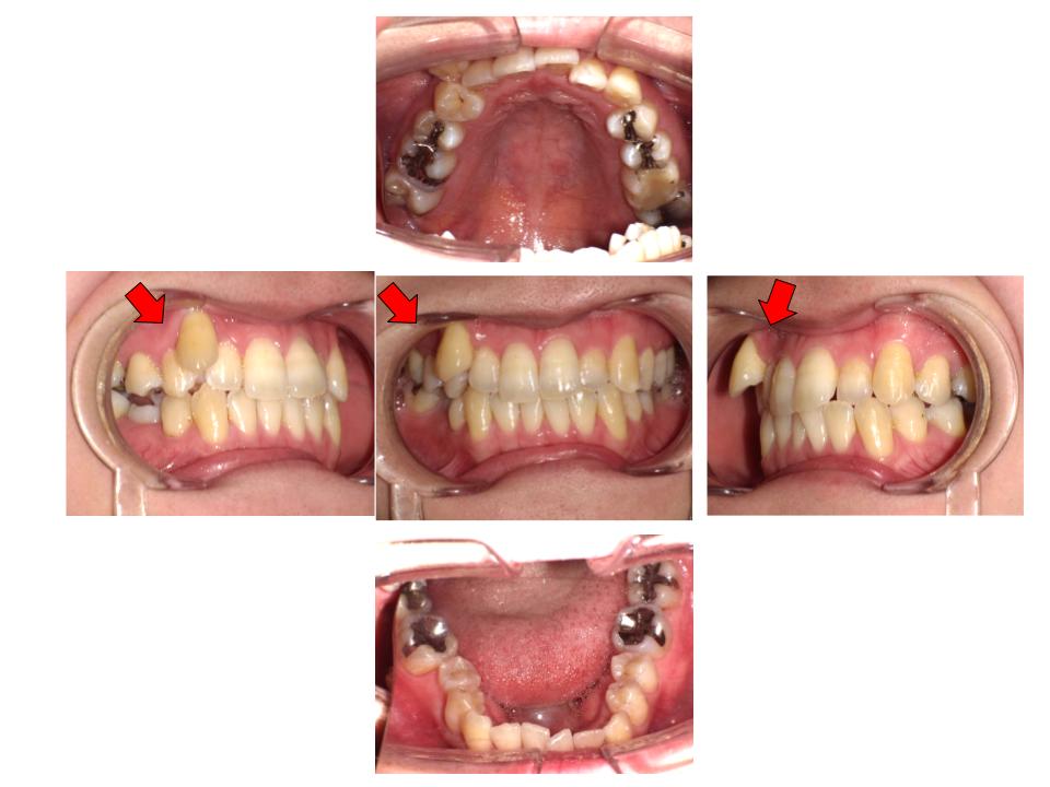 非抜歯矯正（小臼歯をぬかない）（手術をしない） - 小机歯科医院