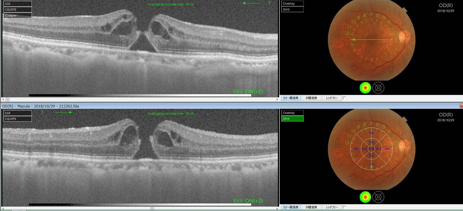日帰り硝子体手術｜茨城県水戸市の小沢眼科内科病院