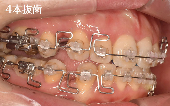 体験談】見た目じゃなく歯を守るために矯正を始めました！ | 新浦安の