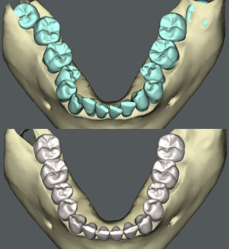 歯を抜かない「非抜歯」矯正治療はどんな場合ができるのか - 【公式