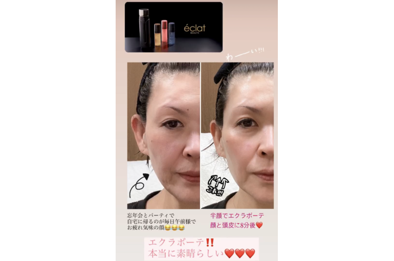 大阪 リアボーテ】リアボーテ美顔器 効果