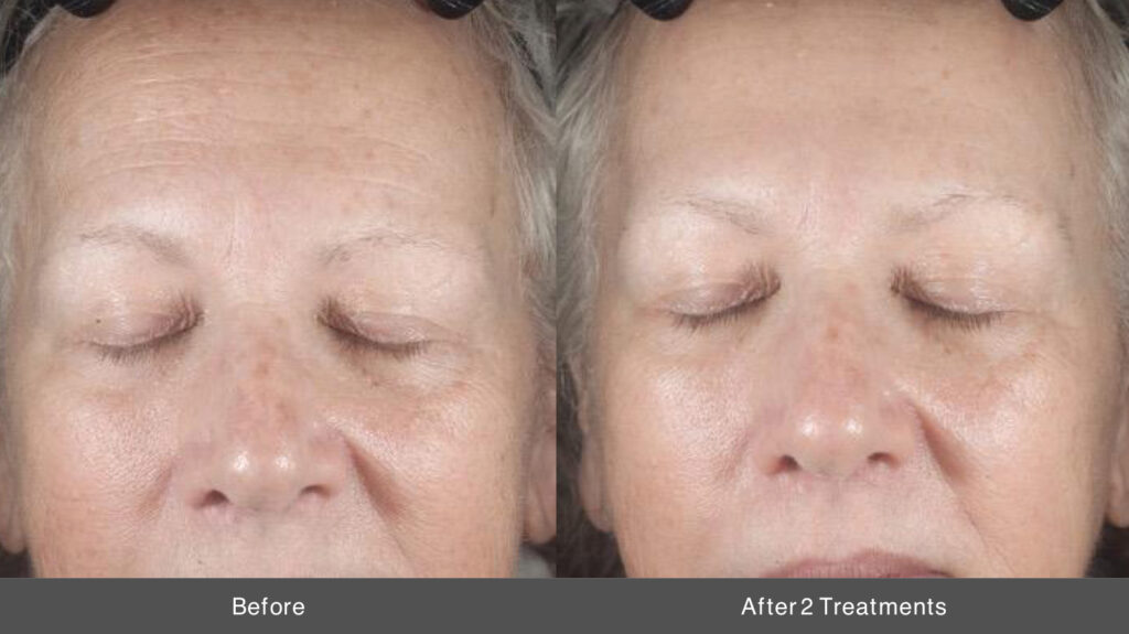 Mosaic 3D – Lani Laser