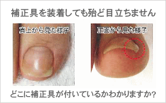 巻き爪補正ベーシックコース – 巻き爪ケア・ヨネクラ｜千葉市稲毛区