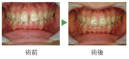 ダイレクトボンディング 審美歯科 診療内容 名古屋市 緑区 歯科