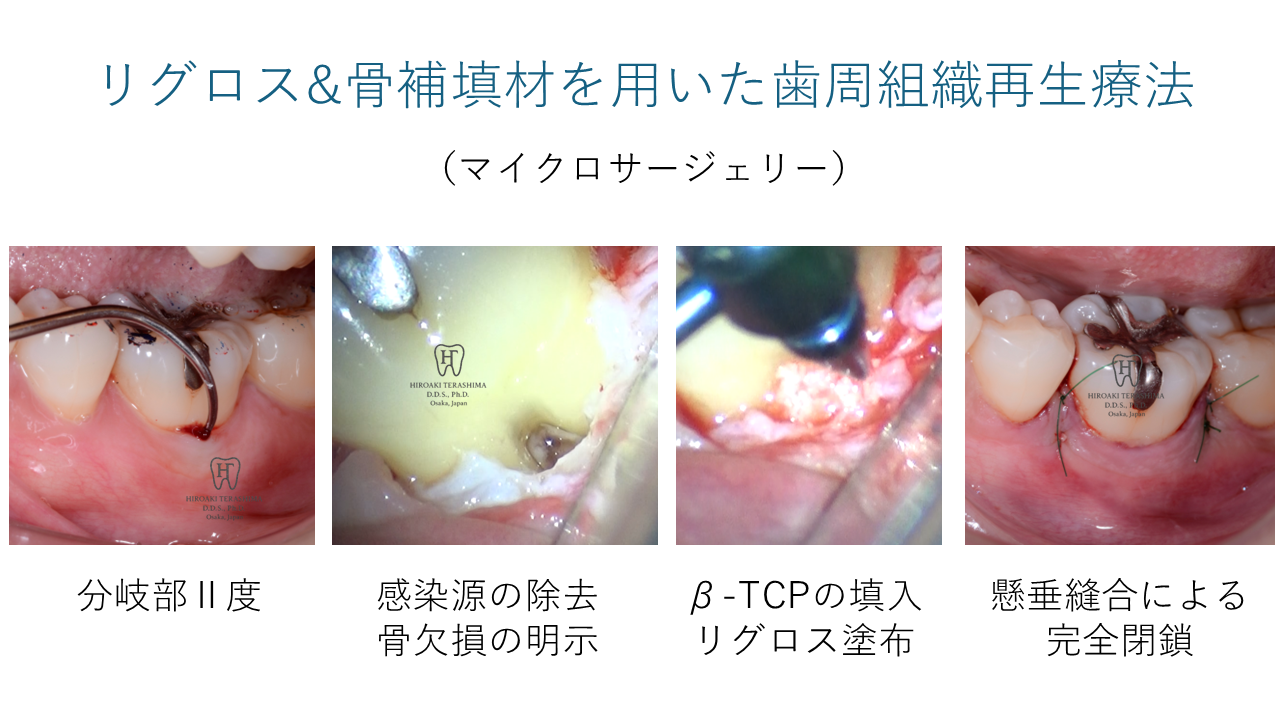 Ⅱ度分岐部病変に対する再生療法で長期安定を得た症例（左下6番・7年7