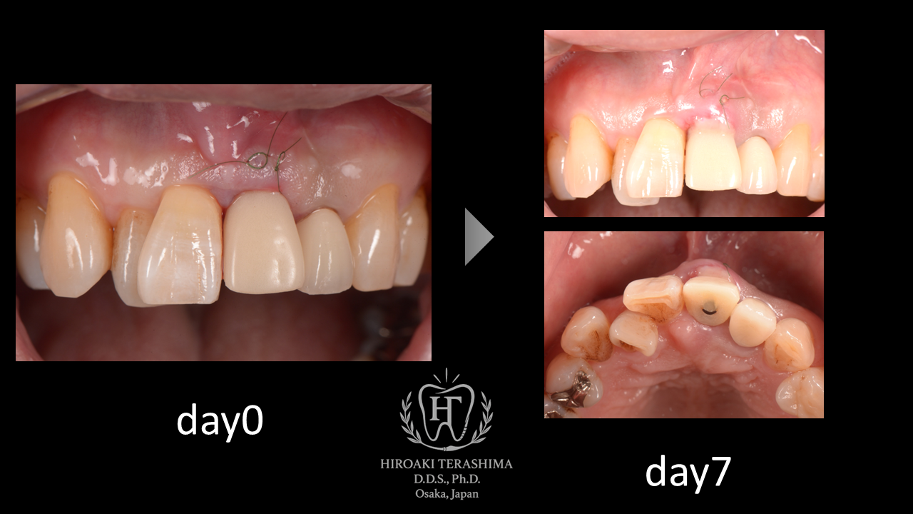 前歯が折れた場合の治療法｜抜歯即時インプラントによる審美回復症例