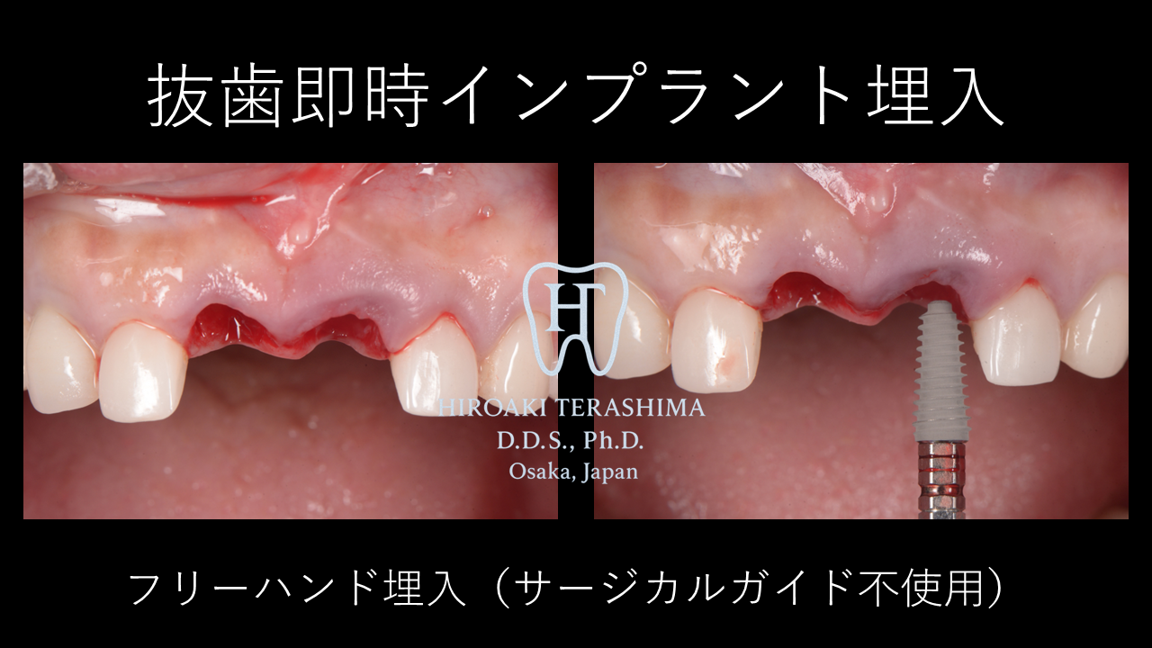 前歯インプラント治療症例 ～ルートメンブレンテクニックで自然な