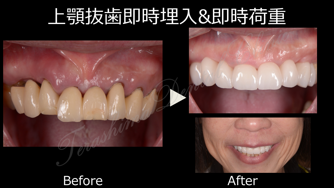 前歯を含む審美インプラント治療～歯の色への価値観は男女で大きく