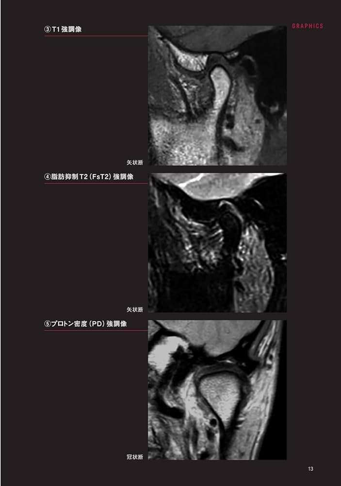 顎関節の画像診断: 臨床医によるMRI・CT読像の手引き | 金田 隆, 箕輪