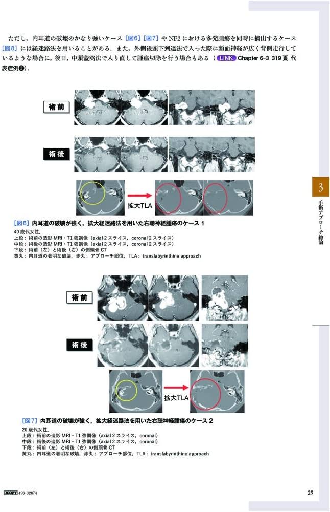 聴神経腫瘍・小脳橋角部腫瘍の手術とマネージメント | 河野 道宏 |本