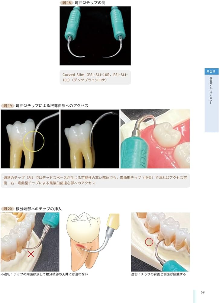 超音波”を攻略せよ ペリオドンタル・デブライドメント: プラス1 | 大野