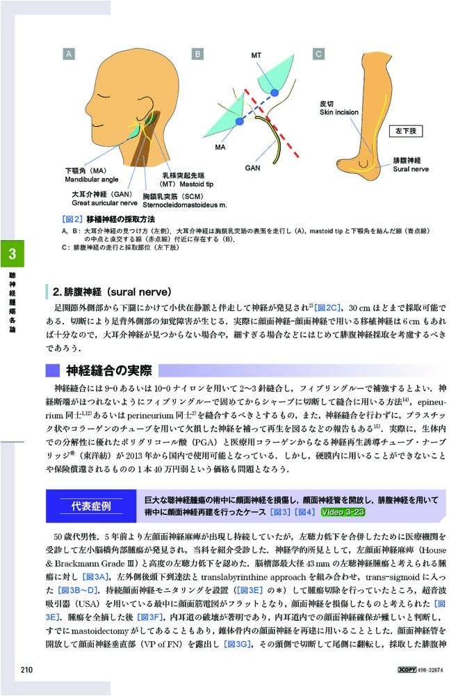 聴神経腫瘍・小脳橋角部腫瘍の手術とマネージメント | 河野 道宏 |本