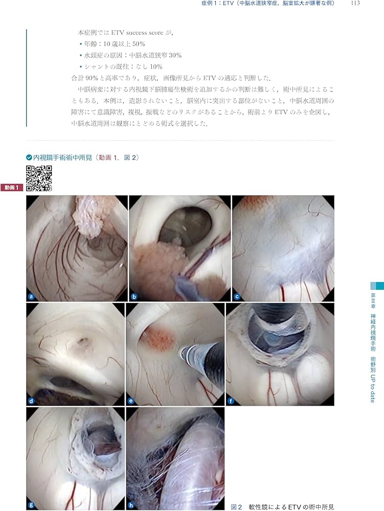 神経内視鏡手術ハンドブック | 永谷 哲也, 村井 尚之, 西山 健一 |本