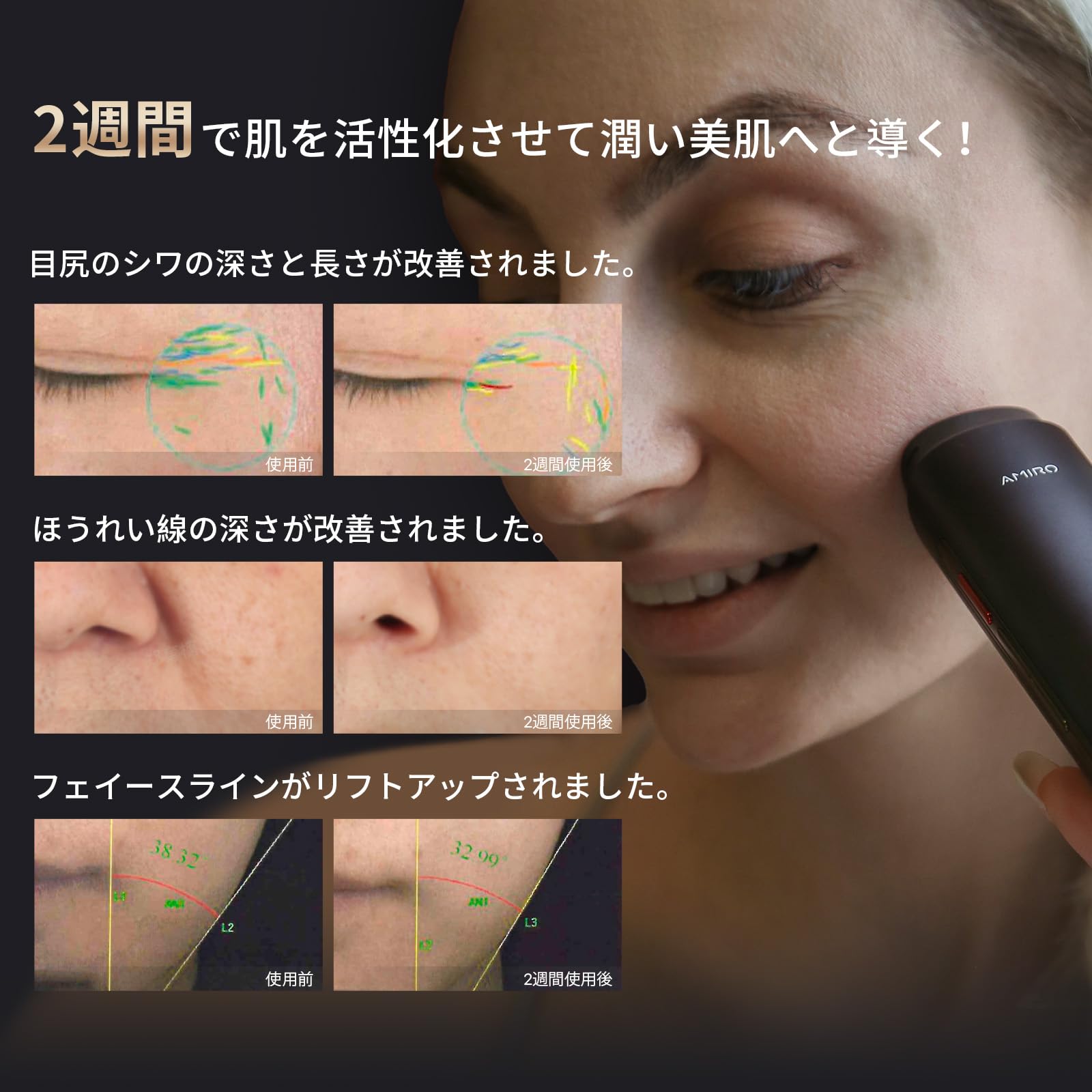 Amazon.co.jp: AMIRO 美顔器 EMS 1台10役 ラジオ波 RF美容器 肌