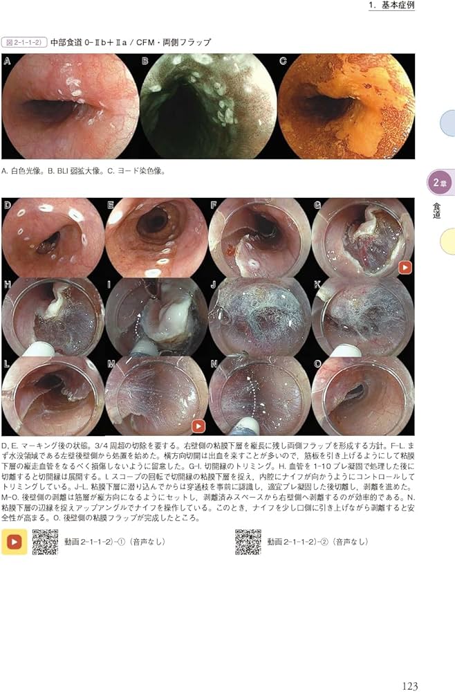 新版ESDアトラス 総論・食道・胃 編[Web動画付] | 豊永 高史 |本