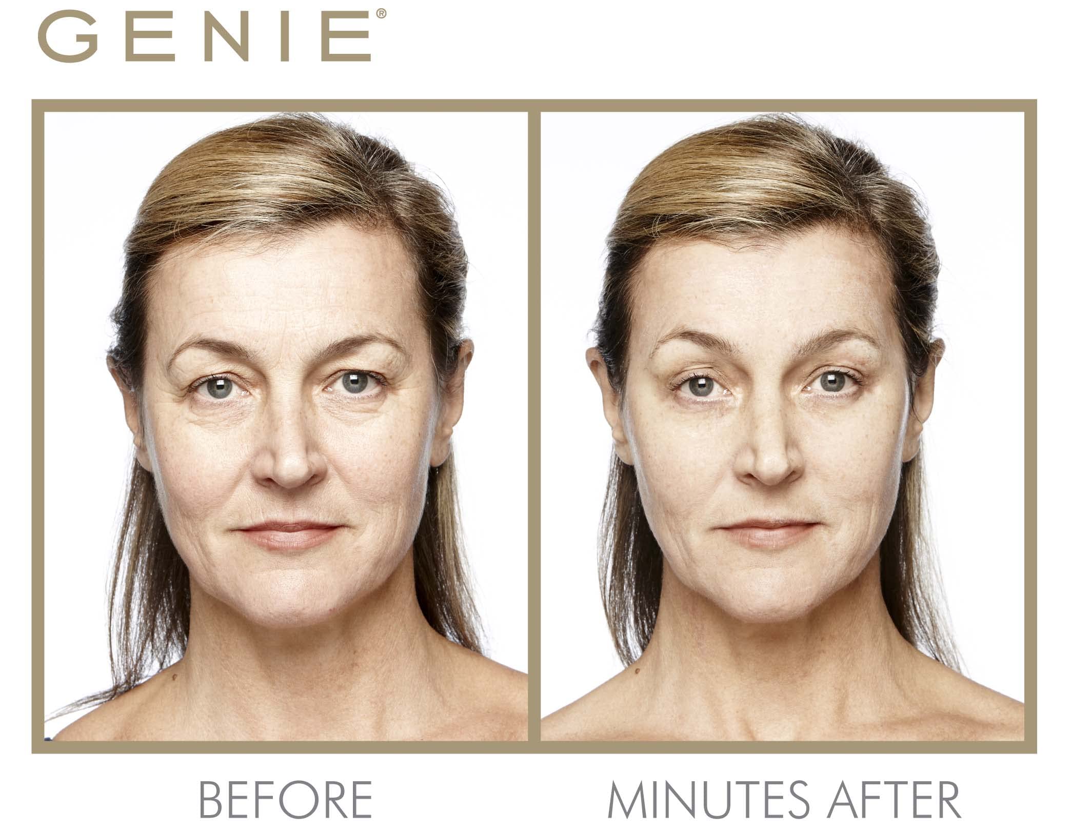 Amazon.com: GENIE Instant Line Smoother (30 ml/1 fl oz) : Beauty