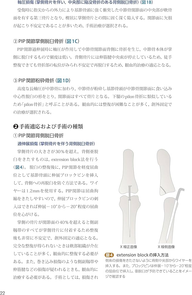 手外科手術ノート part2：代表的な骨折・外傷編 | 大井宏之 |本 | 通販