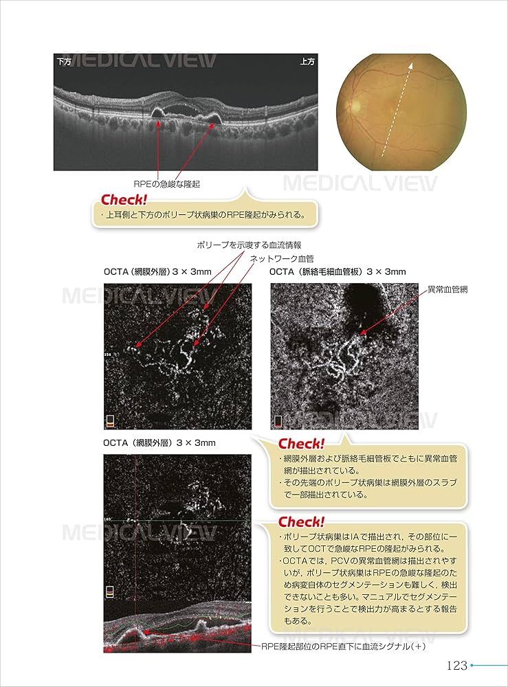 新OCT・OCTA読影トレーニング | 白神 史雄, 飯田 知弘 |本 | 通販 | Amazon