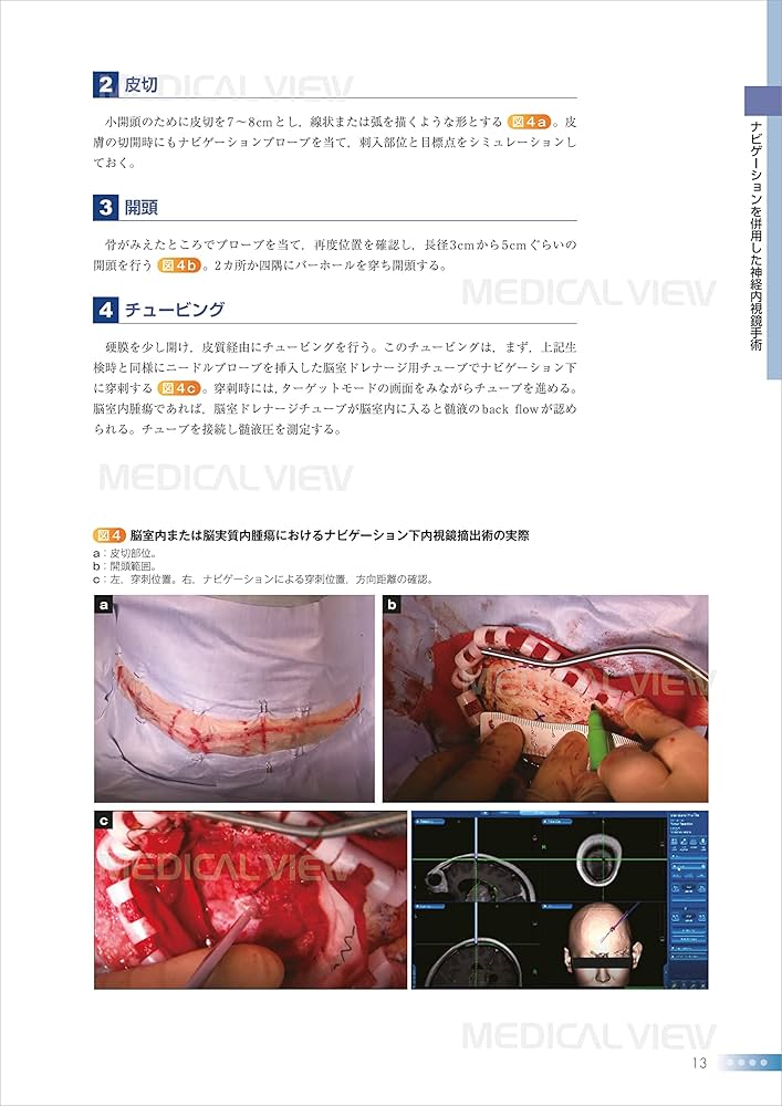 Advanced神経内視鏡手術−神経内視鏡の可能性をさらに拡げる (新NS NOW