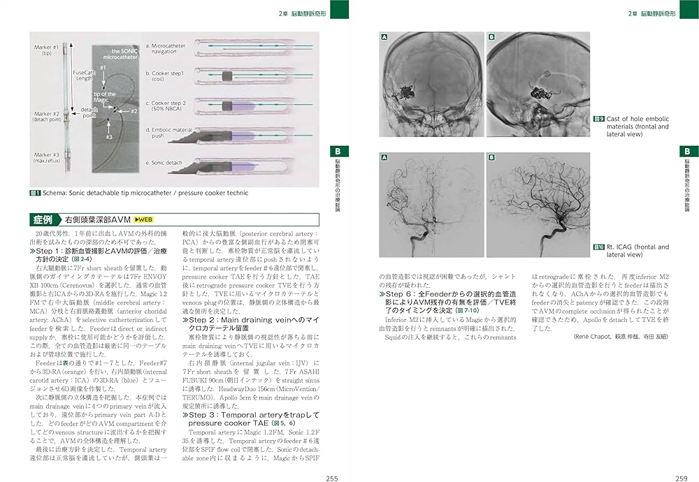 dAVF・AVM（硬膜動静脈瘻・脳動静脈奇形）のすべて：中枢神経系