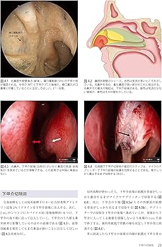 Amazon.co.jp: ウォーモルド内視鏡下鼻副鼻腔・頭蓋底手術 : 本間 明宏: 本