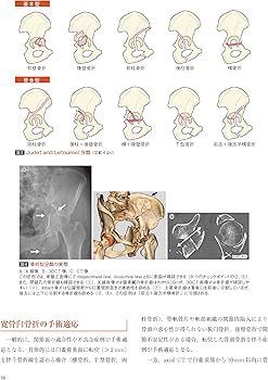 骨盤骨折: 寛骨臼骨折・骨盤輪骨折の手術手技 (整形外科SURGICAL