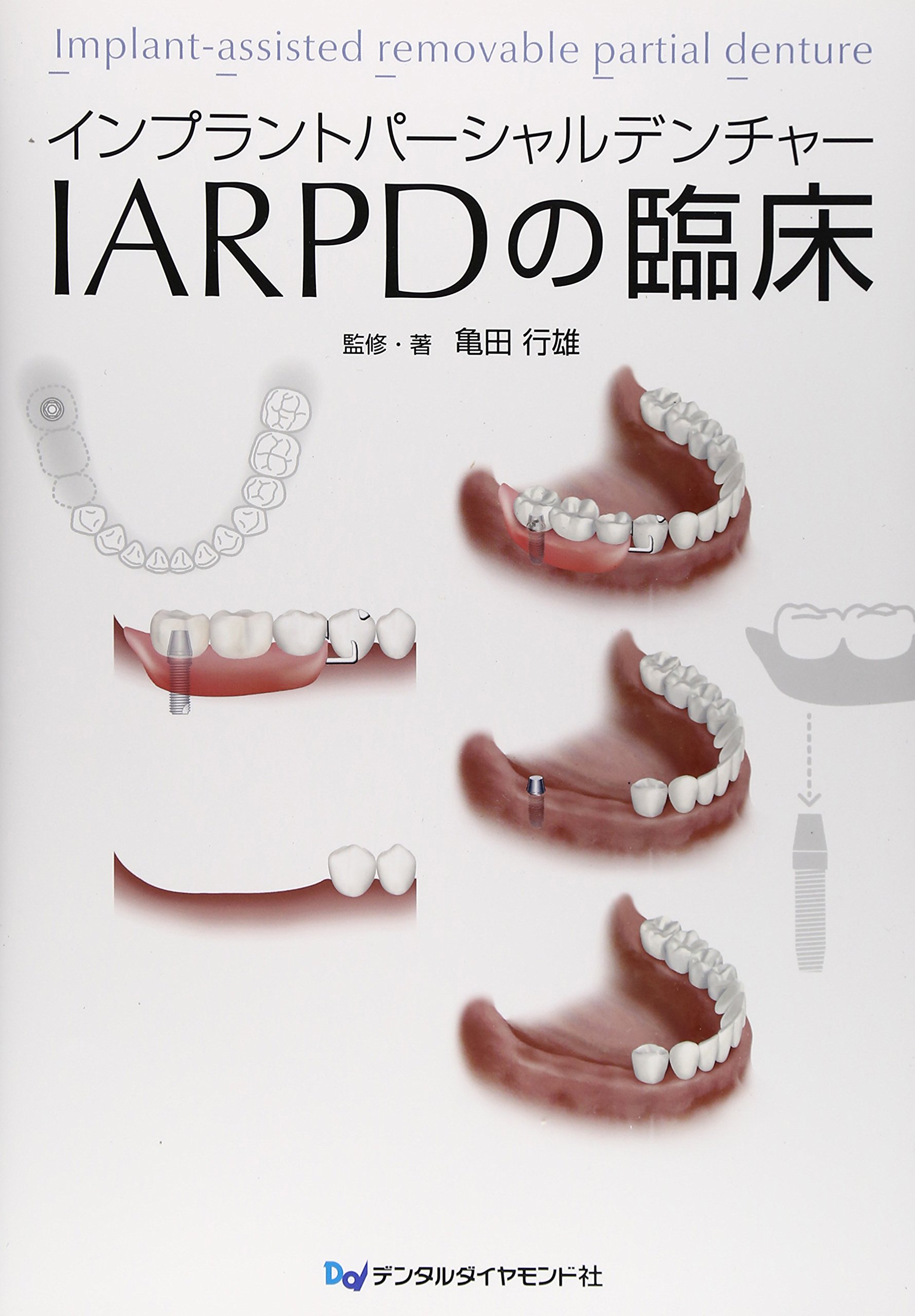 Amazon.co.jp: インプラントパーシャルデンチャーIARPDの臨床 : 亀田