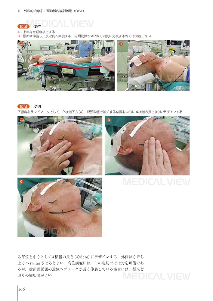 パーフェクトマスター 頚動脈狭窄症 | 永田 泉, 中原 一郎 |本 | 通販
