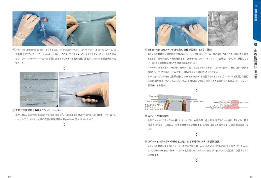 脳血管内治療の基本テクニック：コマ送り解説で知識と技術が結びつく