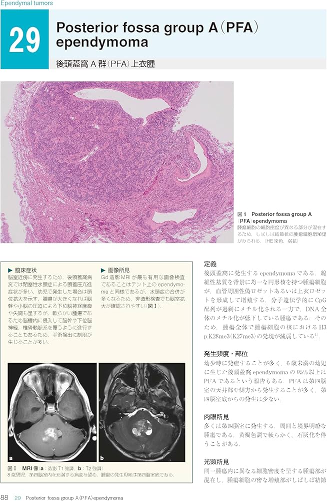 Amazon.co.jp: 脳腫瘍臨床病理カラーアトラス 第5版 : 日本脳腫瘍病理
