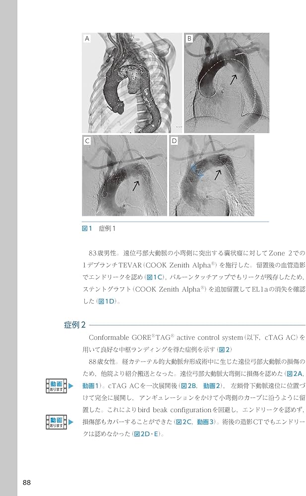 ステントグラフト内挿術マニュアル 胸部編 ─ 動画を含む電子版付