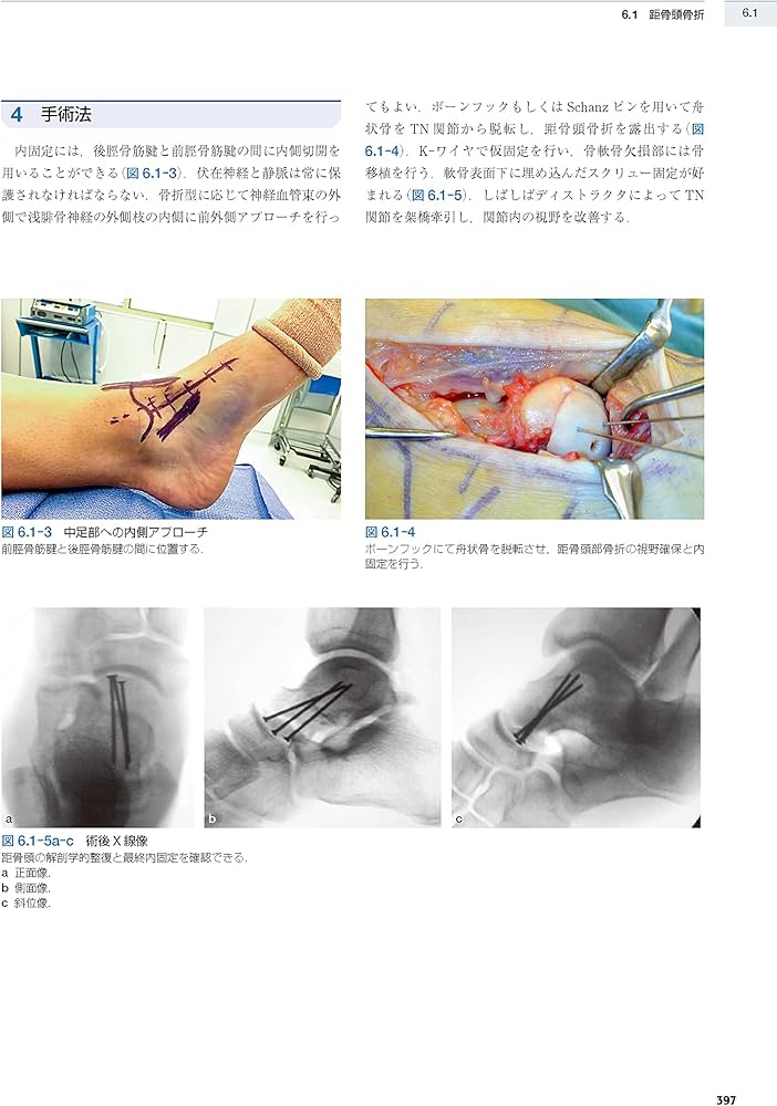 AO法骨折治療 Foot and Ankle [英語版Web付録付] (AOTRAUMA) | Stefan