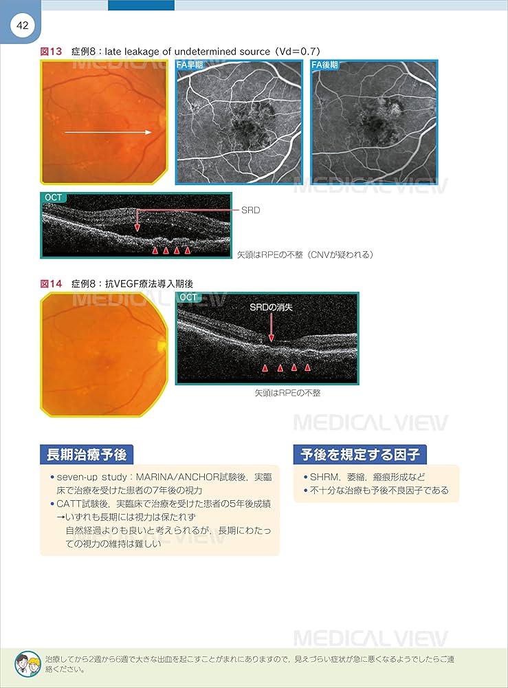 網膜診療クローズアップ 改訂第2版 | 柳 靖雄 |本 | 通販 | Amazon