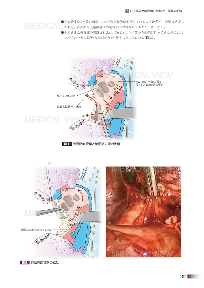 肺癌 (がん研スタイル 癌の標準手術) | 奥村 栄, 文 敏景(編集協力