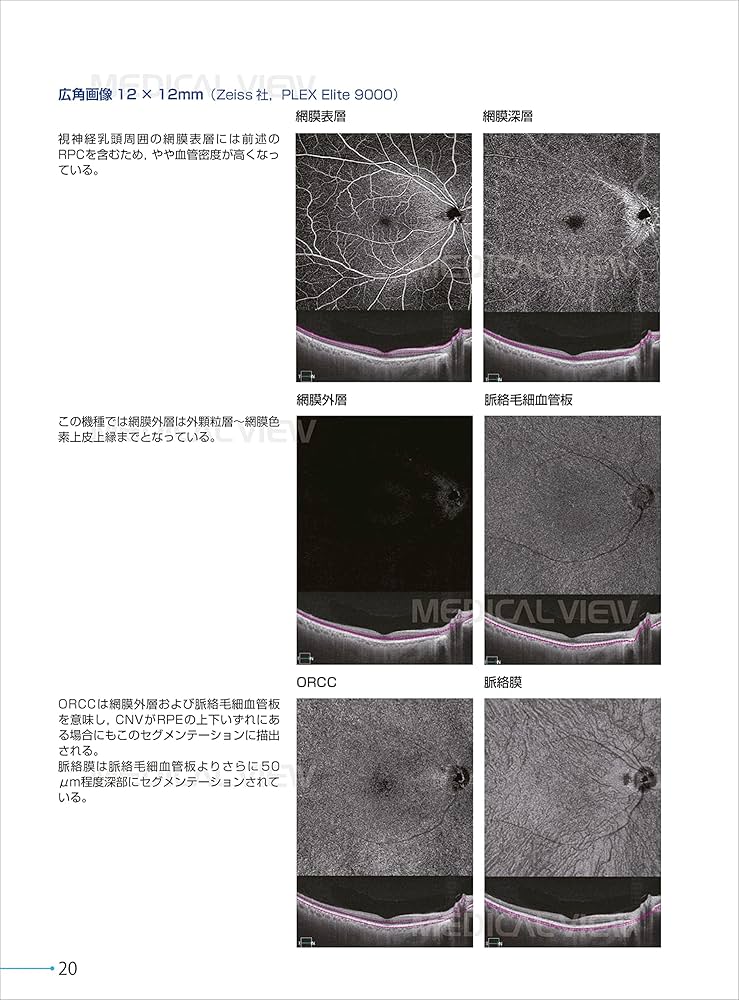 新OCT・OCTA読影トレーニング | 白神 史雄, 飯田 知弘 |本 | 通販 | Amazon