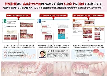無理なくできる根面被覆導入マニュアル | 木村 英隆 |本 | 通販 | Amazon