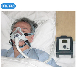 CPAP治療の仕組みと流れを解説｜循環器専門医による合併症予防を重視