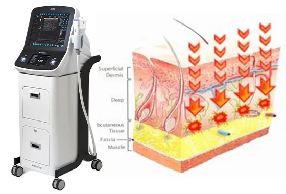 HIFU（ハイフ）-茨城県 水戸中央美容形成クリニック