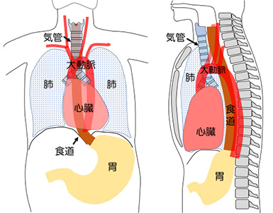 食道がんと食道がんの治療 | 外科 | 診療科・部門 | 水戸医療センター