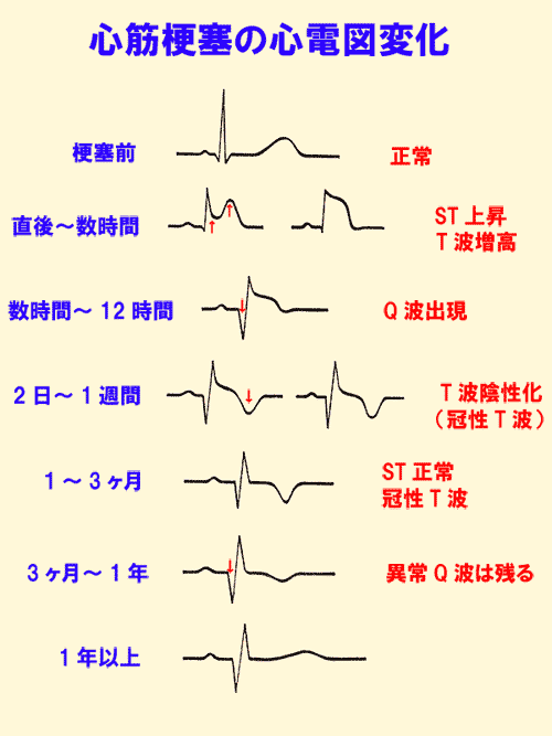8.陳旧性心筋梗塞の心電図｜誰でも分かる「心電図の簡単な読み方