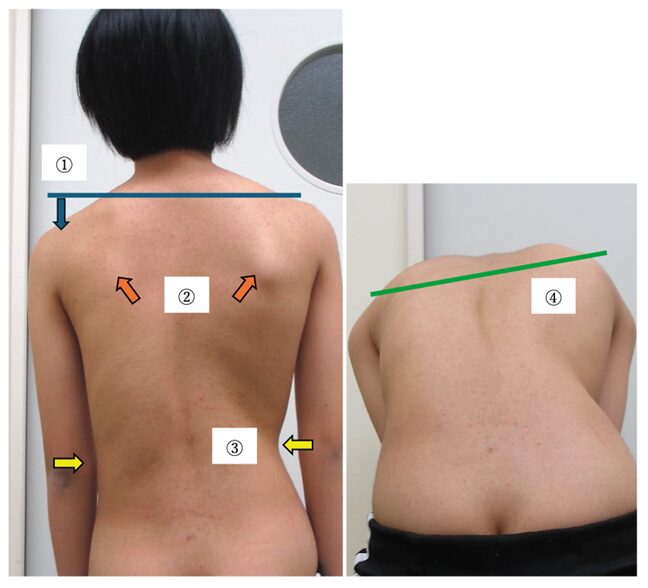 側弯症(思春期特発性側弯症) の症状、原因、治療 | 桃谷うすい整形外科