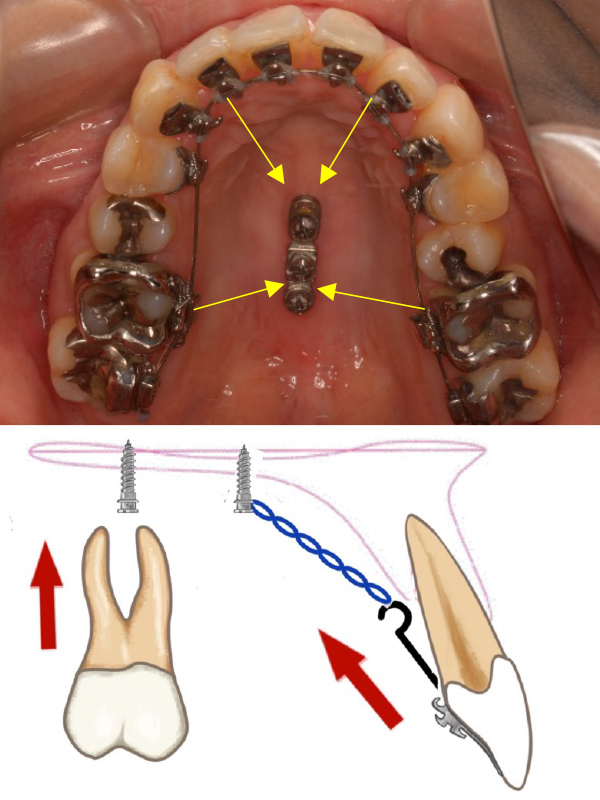 歯科矯正用アンカースクリューを用いた治療｜見えにくい装置で矯正治療