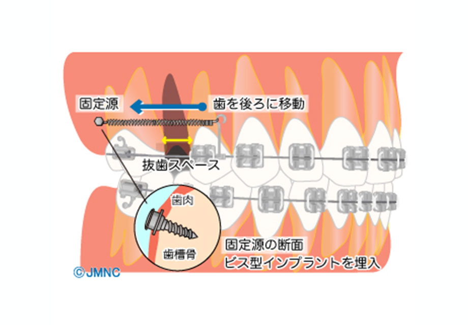歯科矯正用アンカースクリューを用いた治療｜見えにくい装置で矯正治療