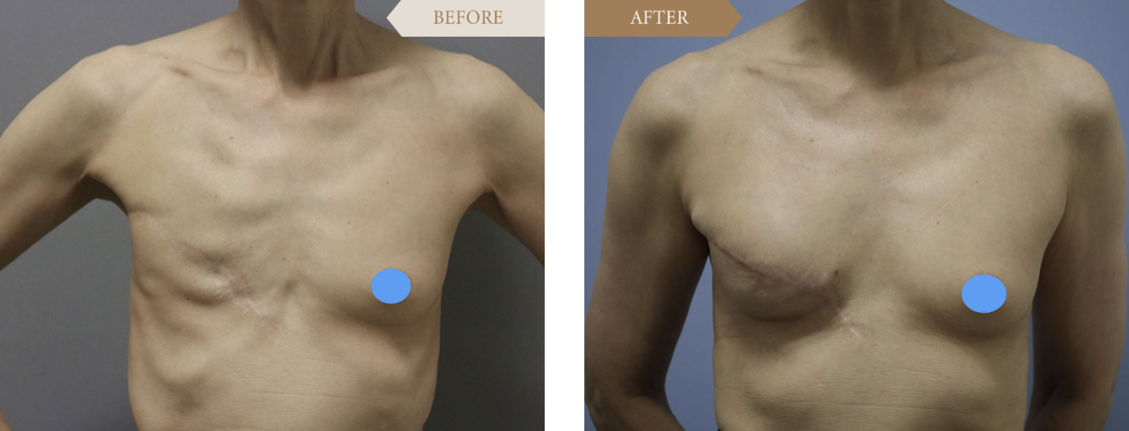 乳がん乳房全摘術後の乳房再建のメリット・デメリット/治療方法と保険