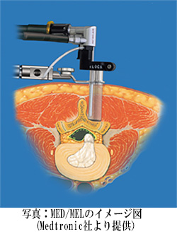 脊椎内視鏡手術「主に内視鏡下椎間板切除術（Microendoscopic