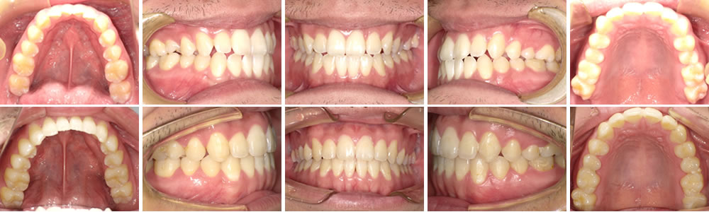軽度の反対咬合(受け口)の矯正治療例（20代男性 治療期間2年8ヵ月