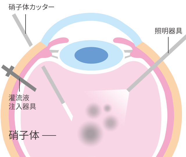 硝子体手術 - 日帰り手術｜眼科なかのぶ医院