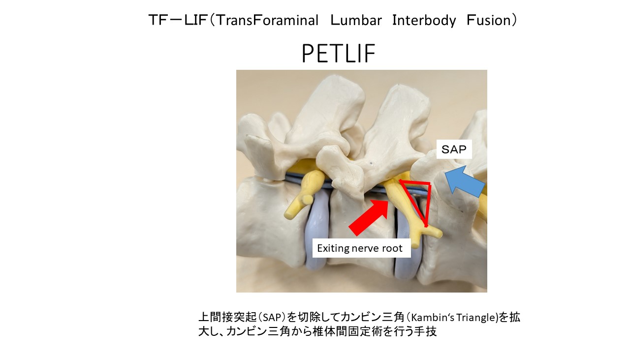 低侵襲脊椎手術PETLIF：短期間で社会復帰を可能にする手術方法 ｜ 成尾