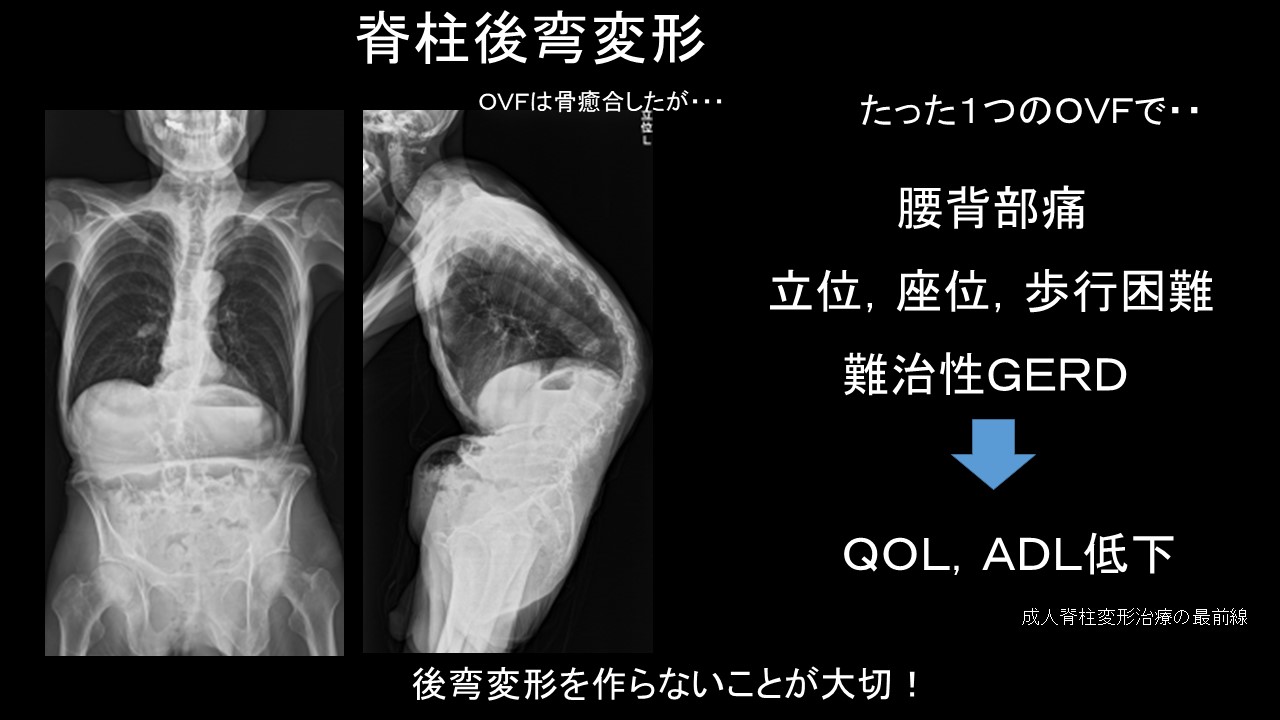 高齢者の転倒と骨折リスク｜BKP治療でQOLを守る新たな選択肢 ｜ 成尾